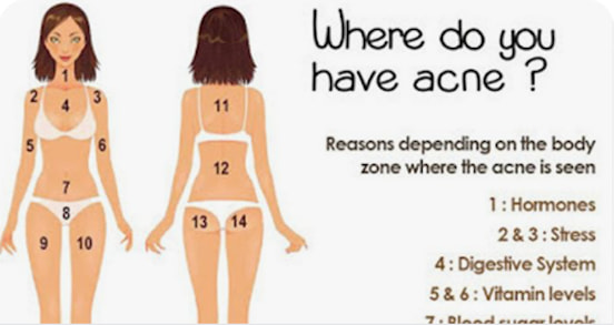 The Location Of Acne On Your Body Has A Secret Meaning You ... diagram of papules 